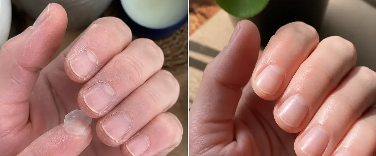 Rough dry cuticles before softer intact skin after plain petroleum jelly